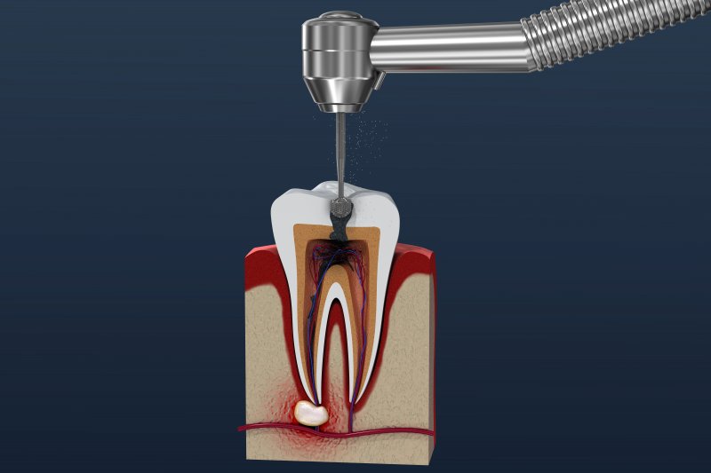 a digital view of a root canal